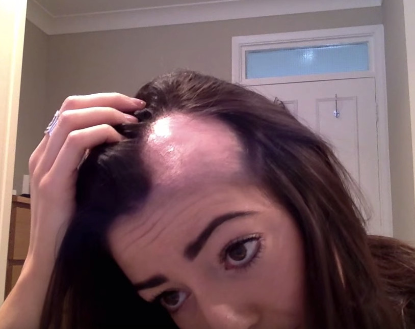 How to grow your hairline or edges back and causes of thining hairline.